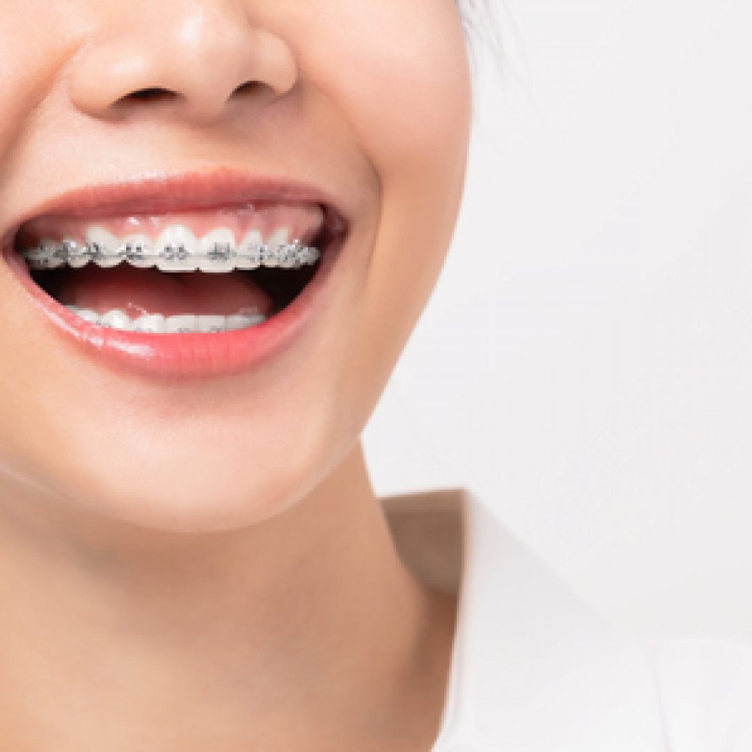 Ortodonzia: Un Sorriso Perfetto