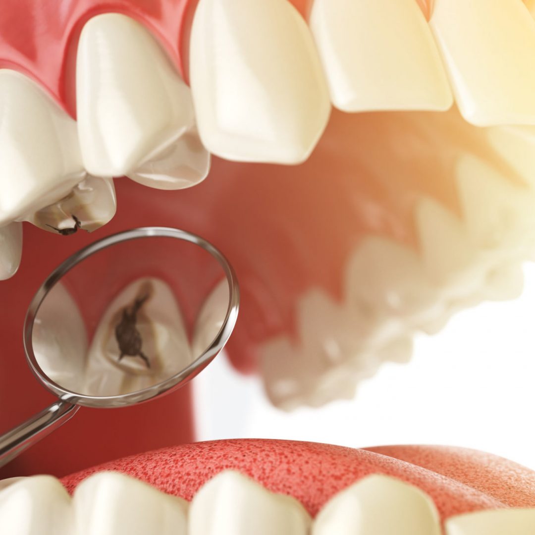 Carie dentarie: prevenirle e trattarle